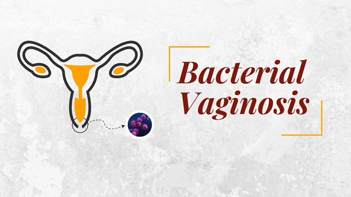 Bacterial Vaginosis: Causes, Symptoms, and Treatment