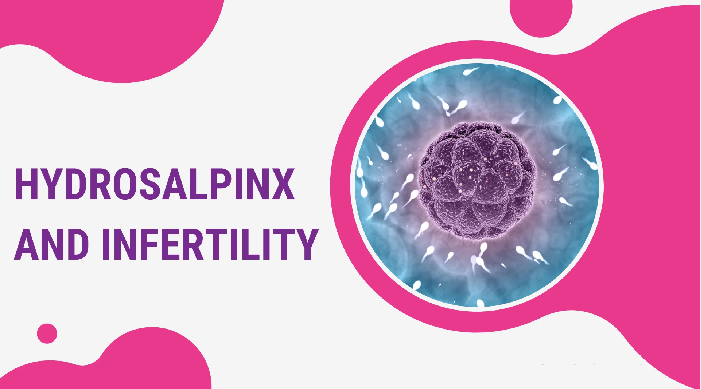 How Does Hydrosalpinx Affect Fertility, And What Can Be Done About It?